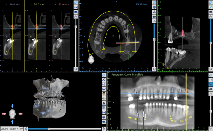 Plan leczenia implantologicznego szczęki i żuchwy na podstawie tomografii CBCT
