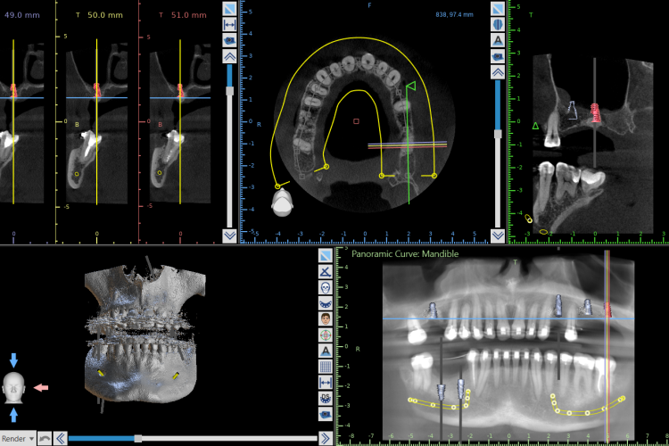 Plan leczenia implantologicznego szczęki i żuchwy na podstawie tomografii CBCT