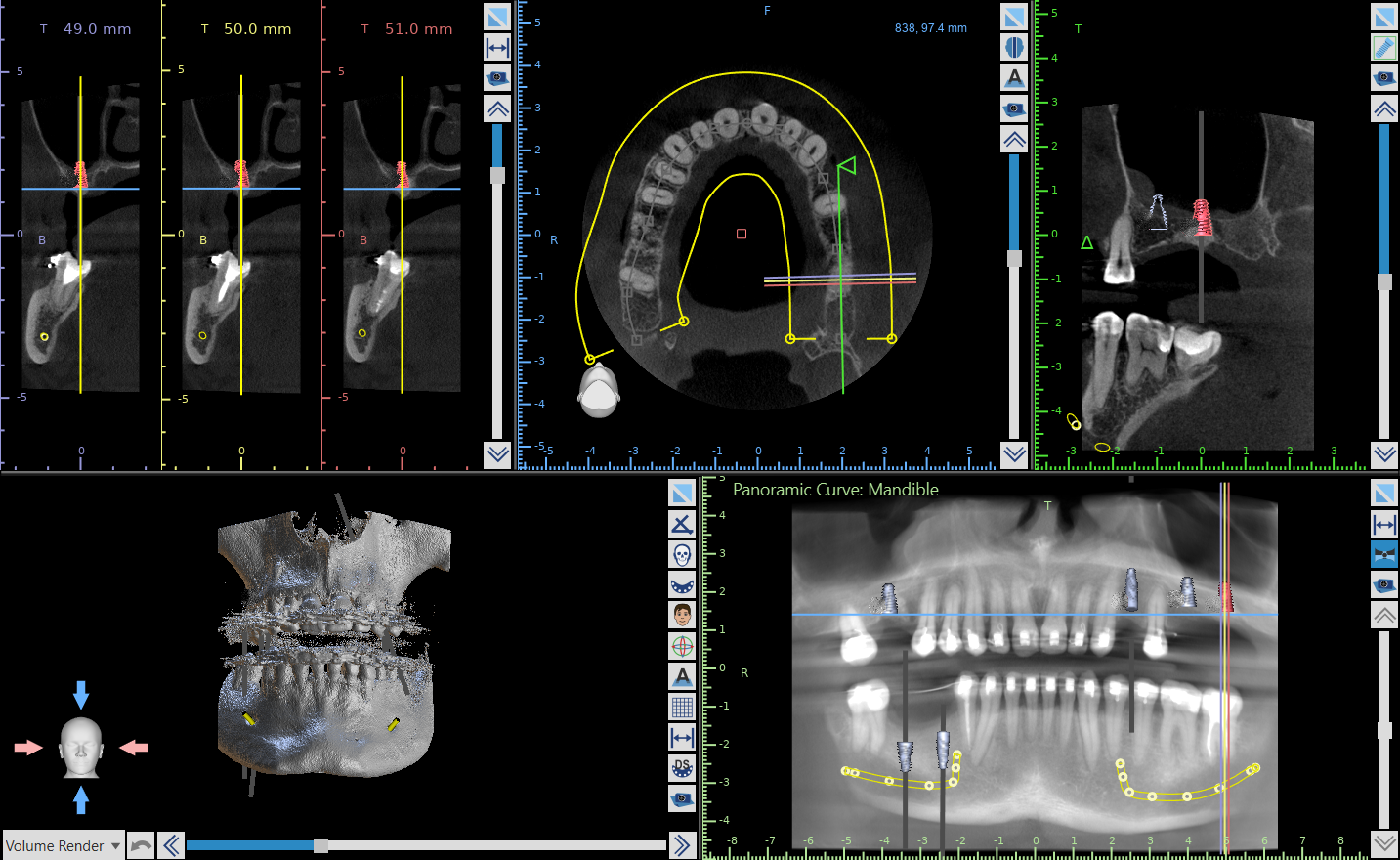 Plan leczenia implantologicznego szczęki i żuchwy na podstawie tomografii CBCT
