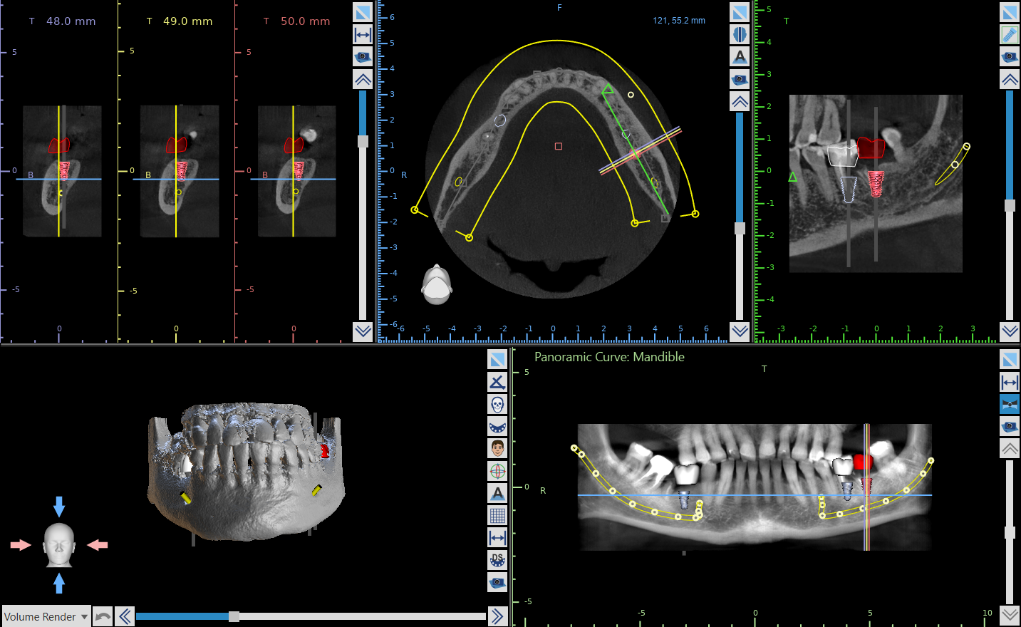 Planowanie implantów w żuchwie na podstawie tomografii CBCT: przekroje kości, widok osiowy łuku, zdjęcie panoramiczne i model 3D