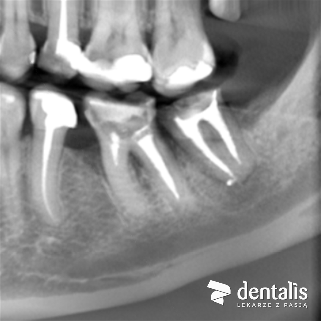 Obraz z tomografii CBCT po powtórnym leczeniu kanałowym: kanały korzeni wypełnione na całej długości