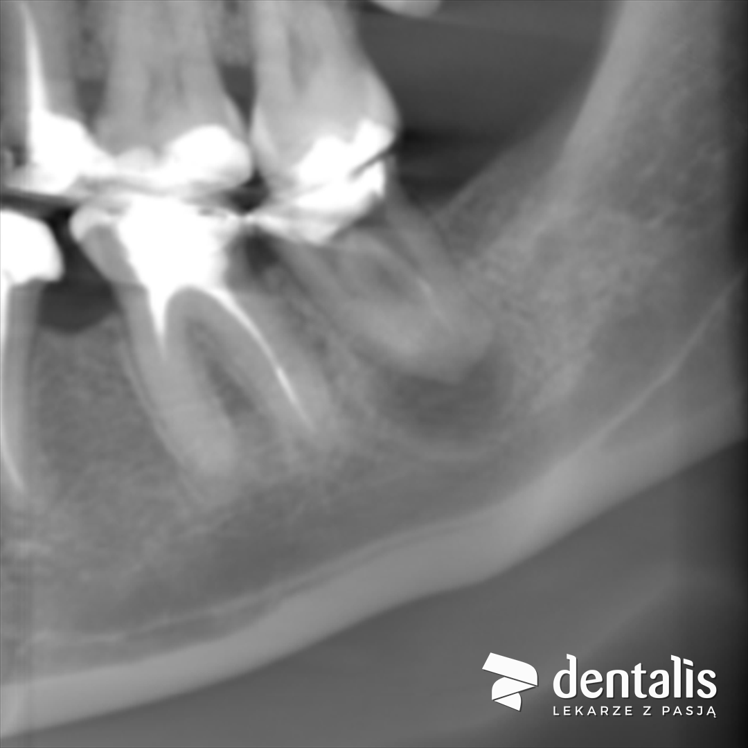 Obraz z tomografii CBCT przed powtórnym leczeniem kanałowym: zęby żuchwy po wcześniejszym leczeniu kanałowym
